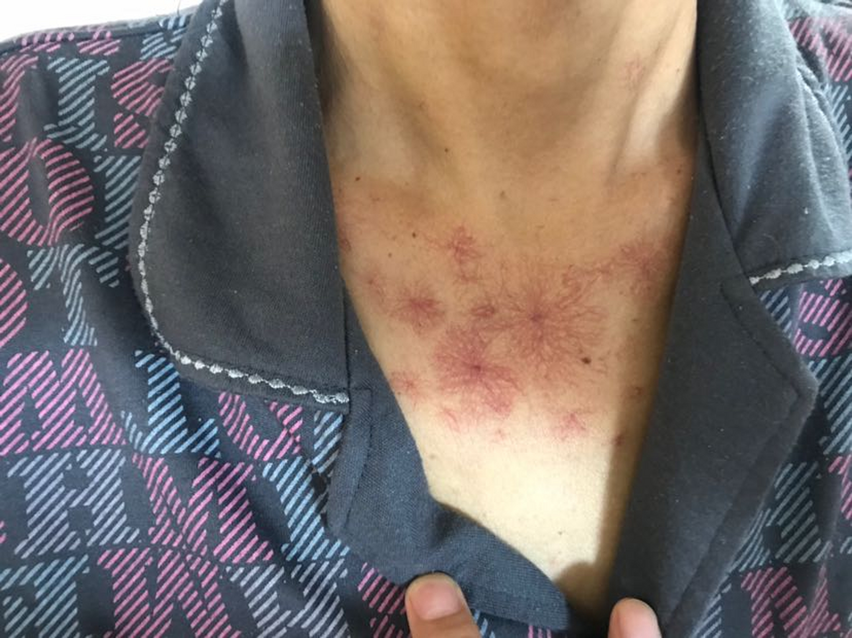 乙肝患者身上出现小红点要引起注意了今天来了一位小伙子,今年才21岁