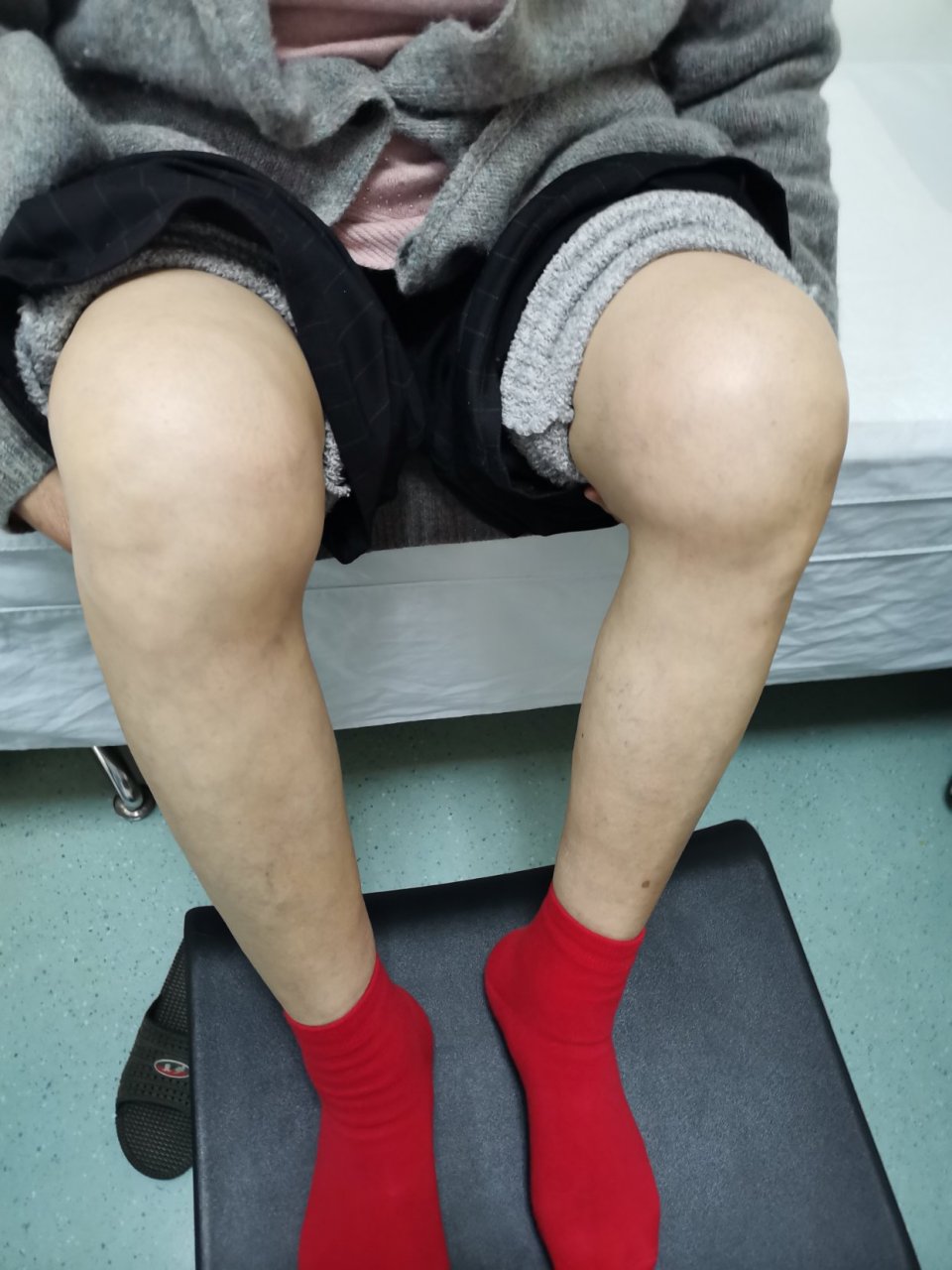 72岁阿姨,本命年 共和国同龄人 膝关节疼的厉害,变形了 膝关节骨性