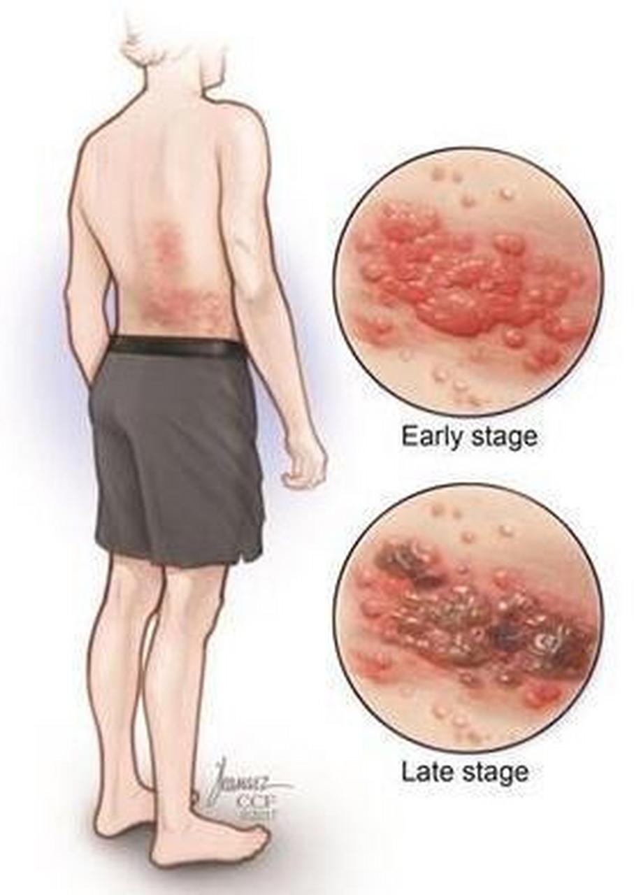 #带状疱疹# 我在临床实践中遇到过很多患有带状疱疹的患者.以下是我在