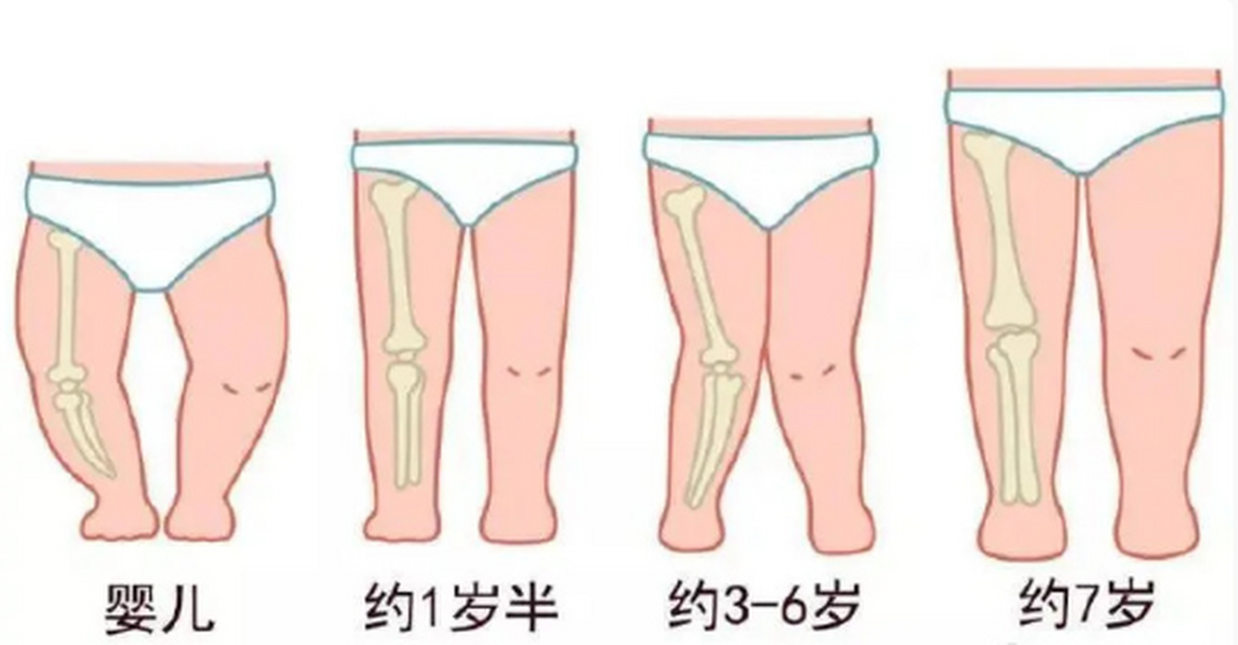 很多宝宝的腿在2岁以前看上去都有一点弯曲,有些宝宝的腿会在他10岁的