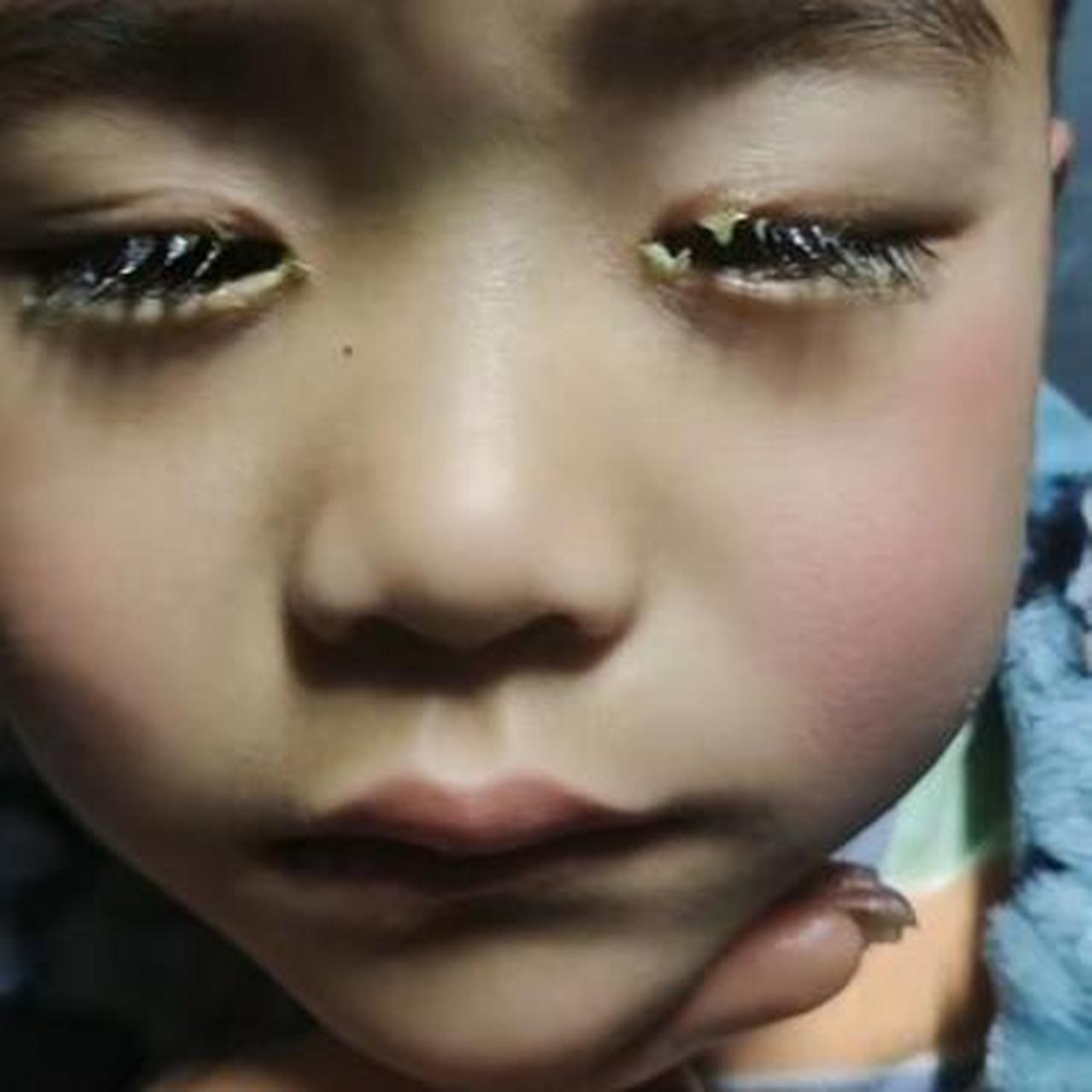 天啊,这孩子的眼是怎么了,眼屎这么多,眼镜都睁不开了.