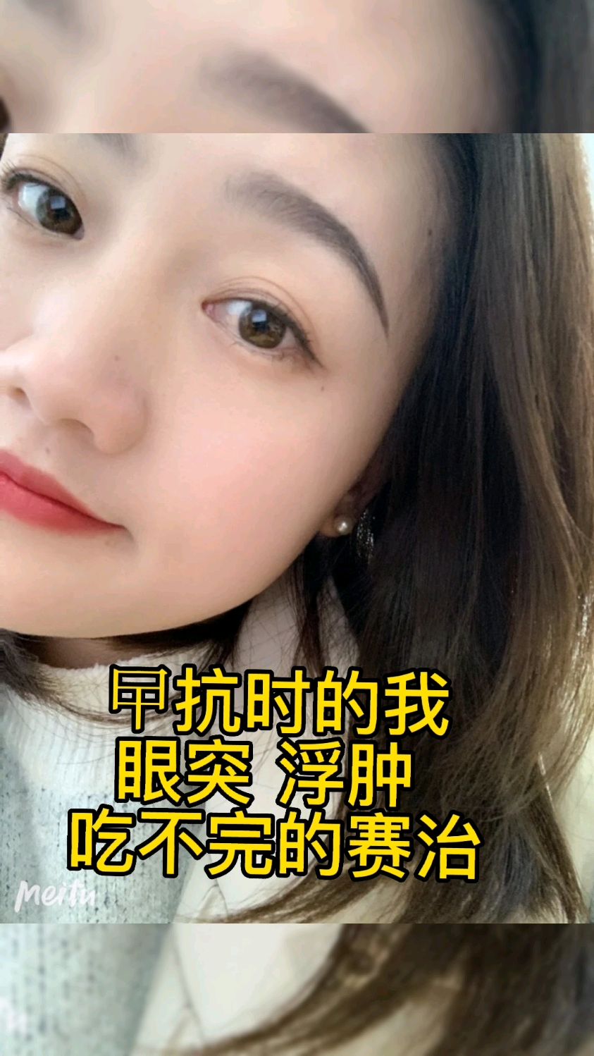 甲亢眼眼突浮肿终于说再见了