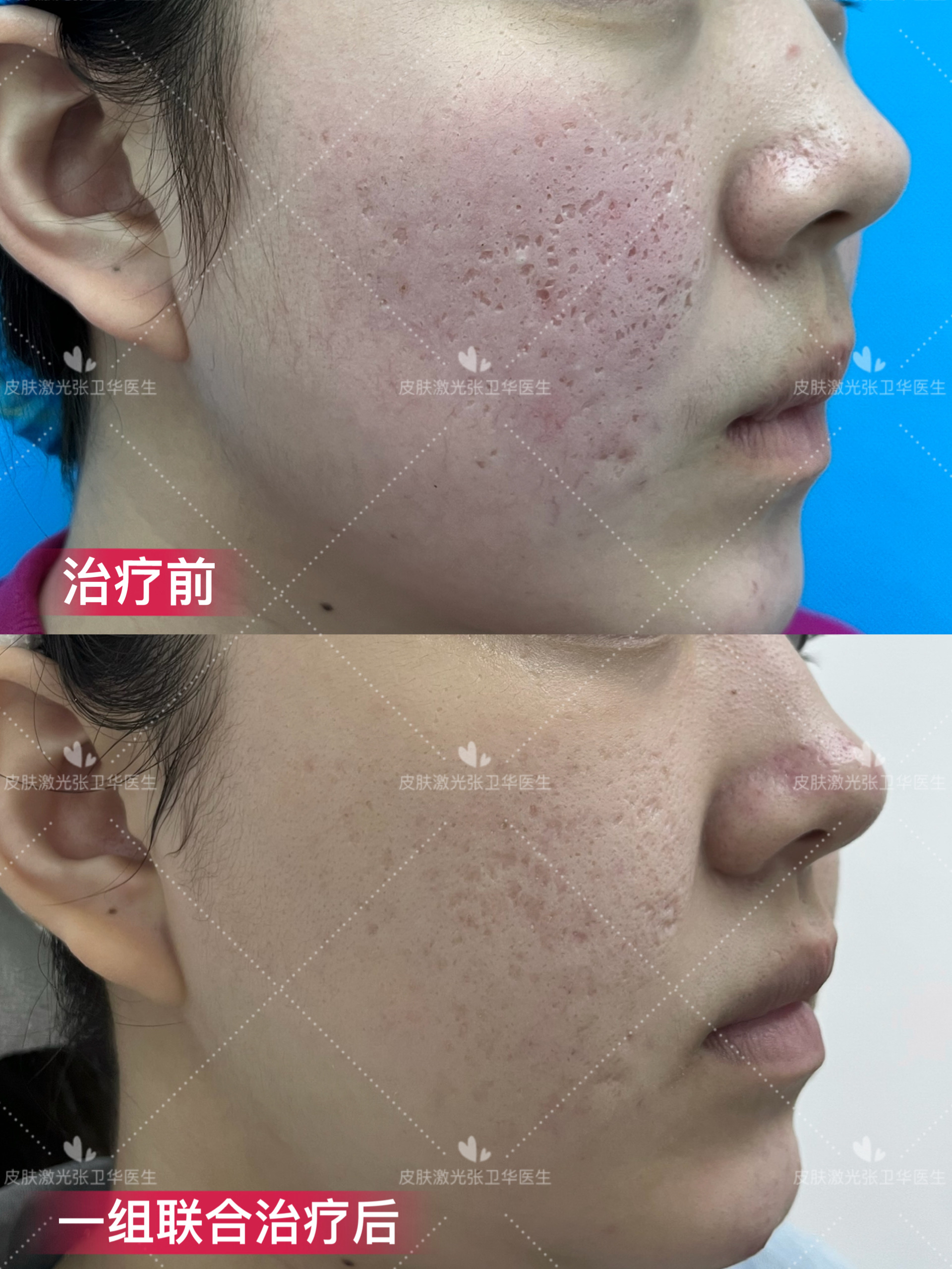 严重车厢型加深锥型痘坑一组联合治疗后效果图,变化惊人!