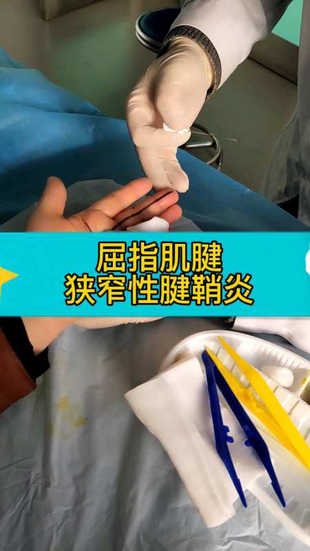 针刀治疗屈指肌腱狭窄性腱鞘炎