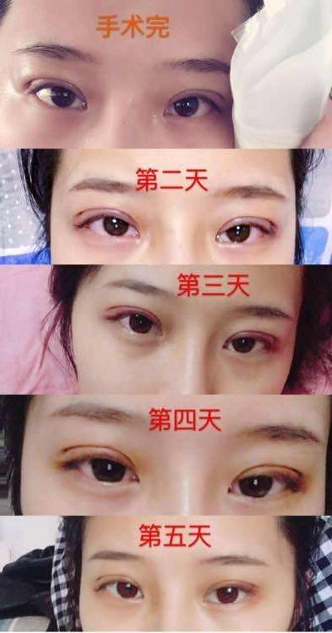 埋线双眼皮能维持几年?