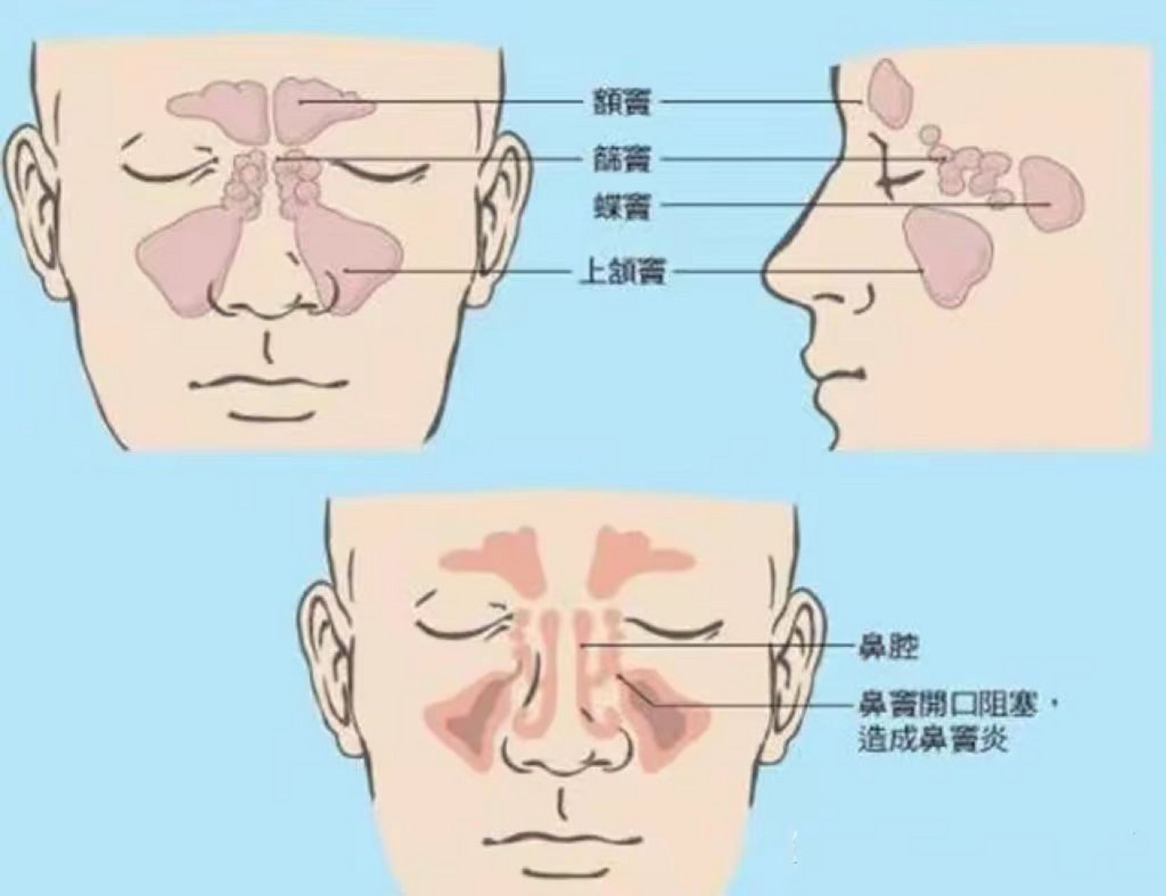 鼻炎示意图图片