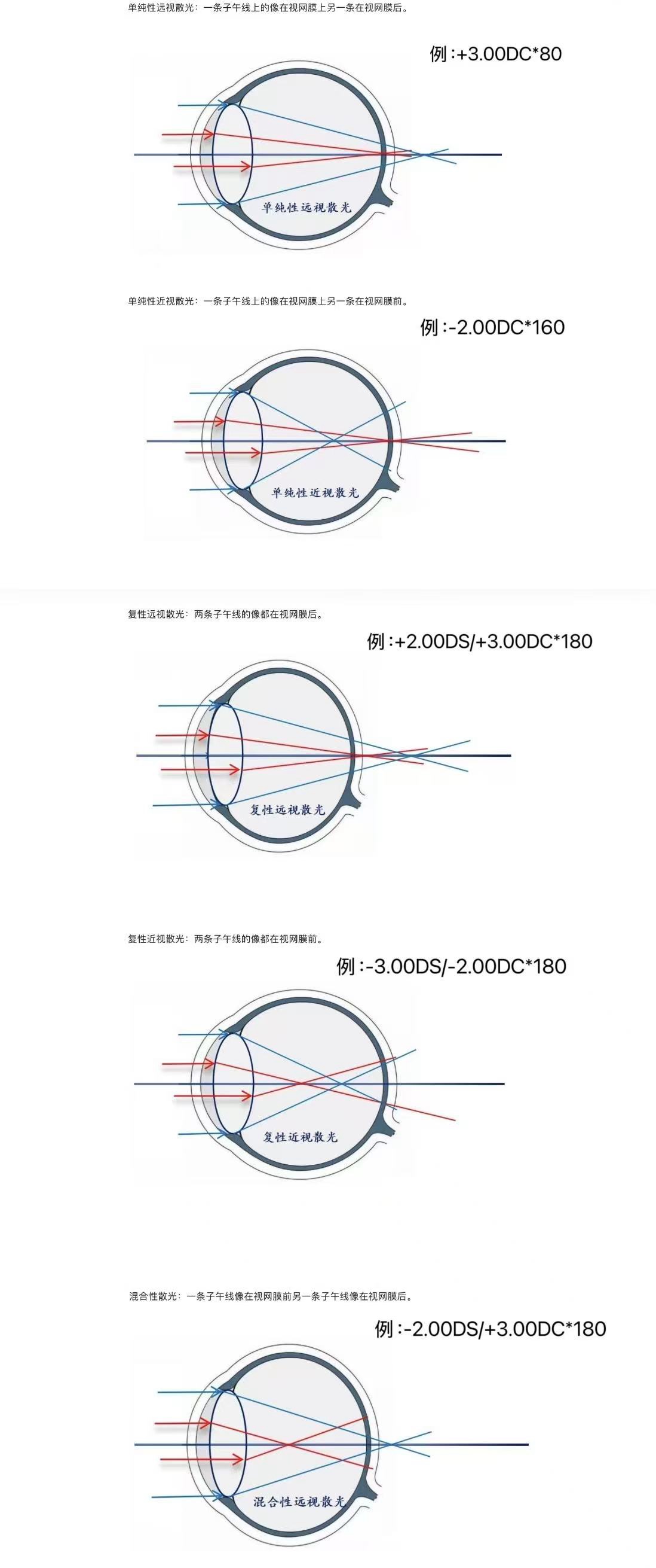 散光是由于眼球在不同子午线上屈光力不同,平行光线经过该眼球屈光