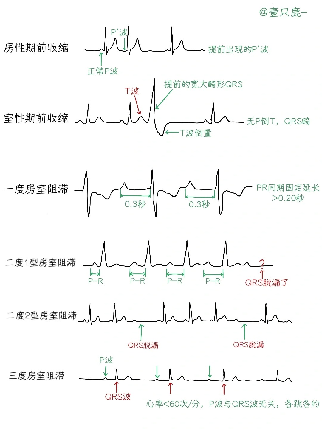 心电图机的使用及图解图片