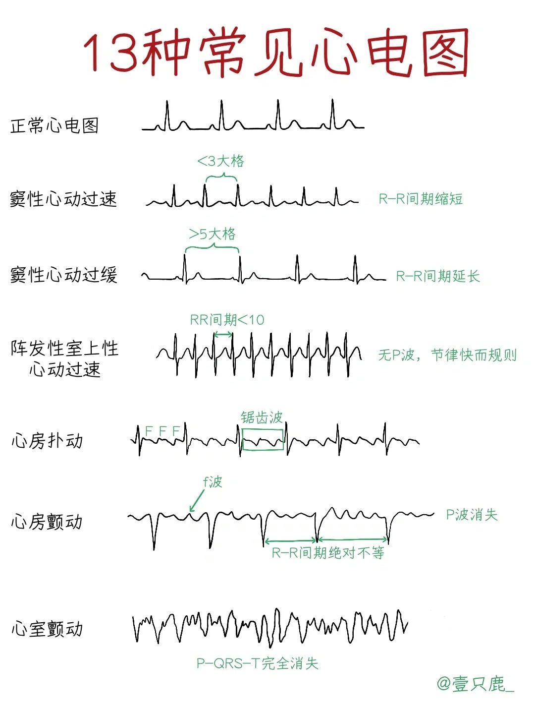 心电图T波双向图片