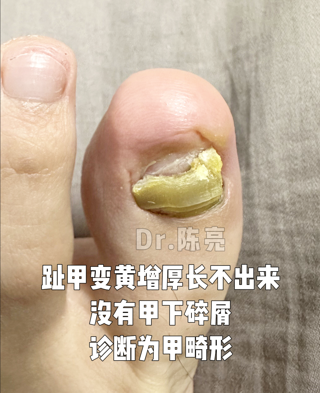 案例分析:甲畸形术后5个月恢复