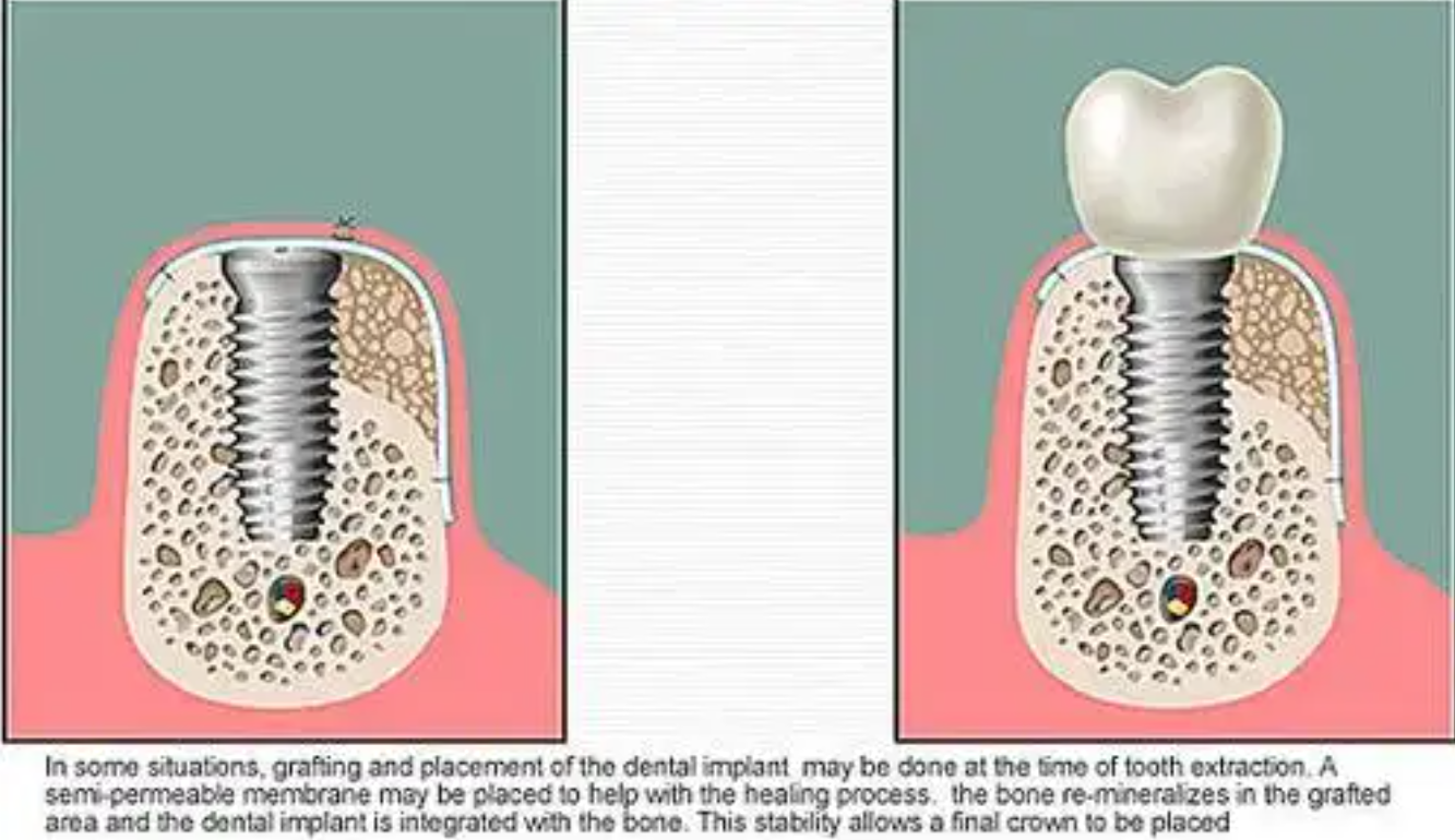 种牙为啥什么要植骨?植骨原因,适用人群及护理,看这篇就懂!