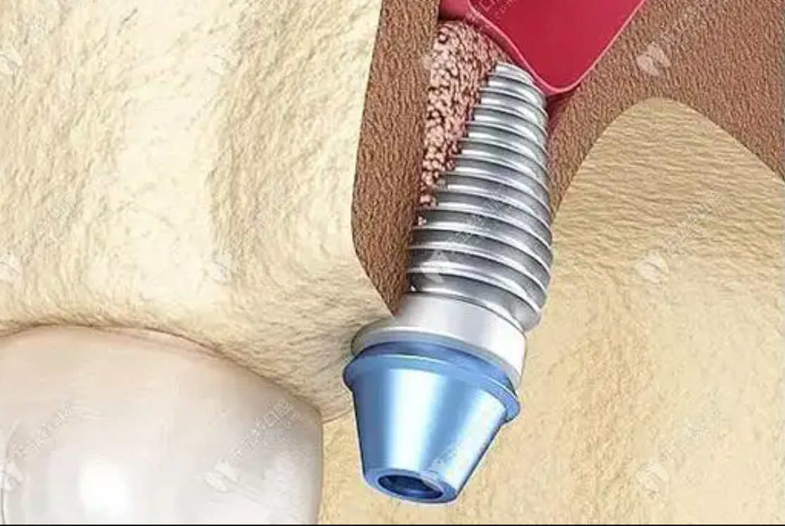 种植牙一定要植骨吗?疼不疼?哪些情况要植骨?一文讲的明明白白!