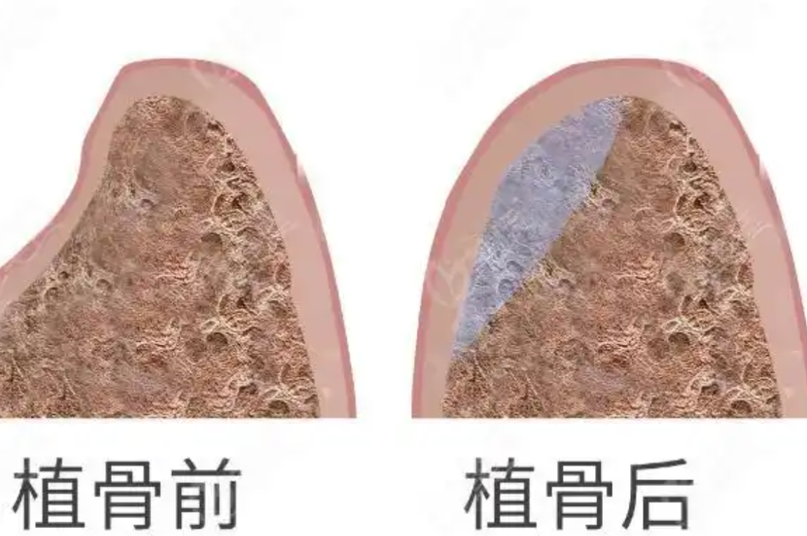 种植牙植骨是智商税吗?一篇文章说清植骨必要性与医生选择指南!