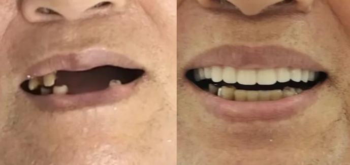 种牙都多少钱