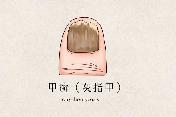 灰指甲"传染性"极高,不能不防!