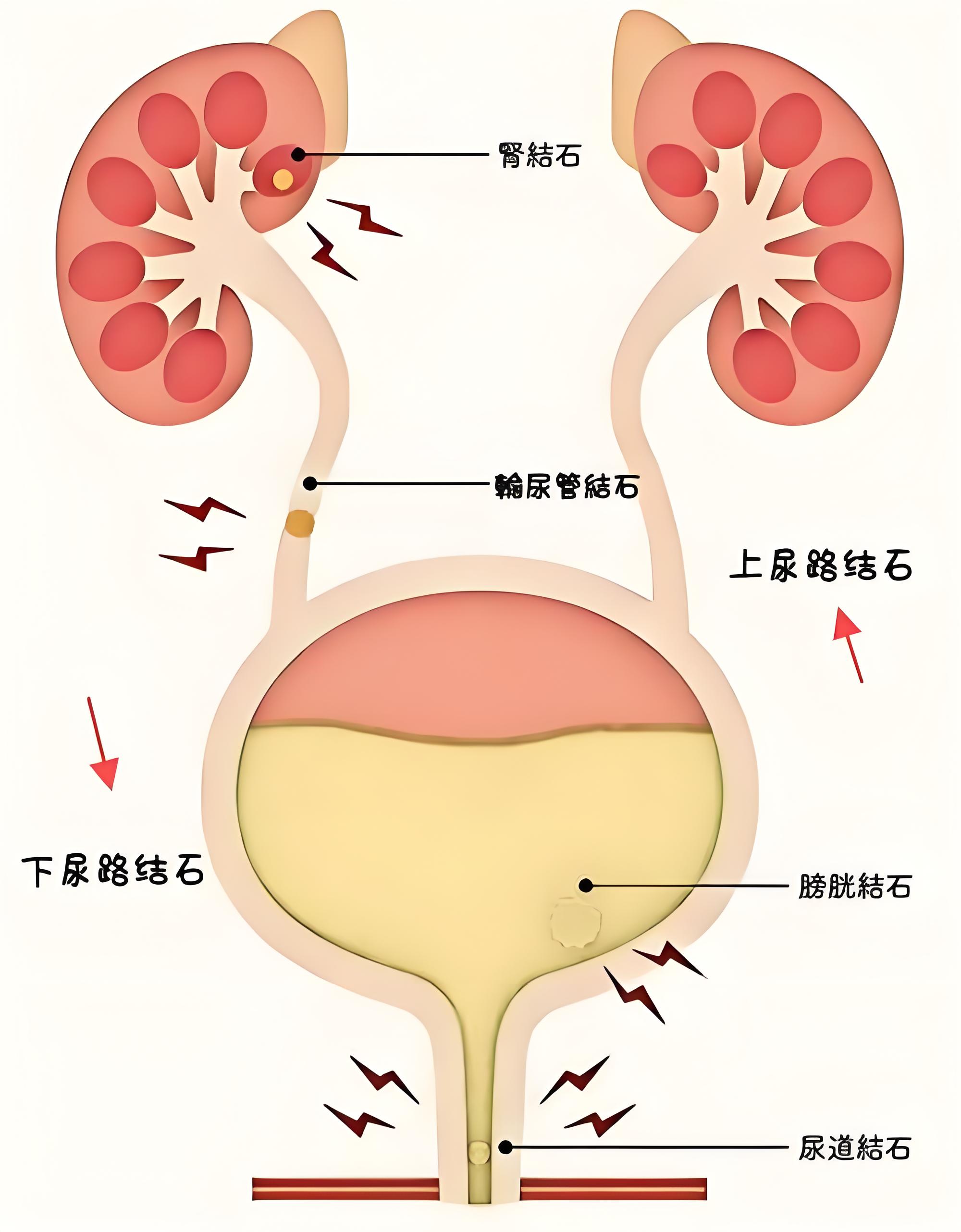 身体里的"小石头"从哪来?说清泌尿系统结石成因