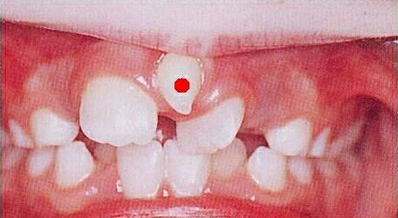 儿童"多生牙"是怎么形成的