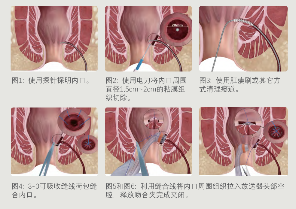 6种肛瘘手术的优劣~肛瘘患者不看一定后悔