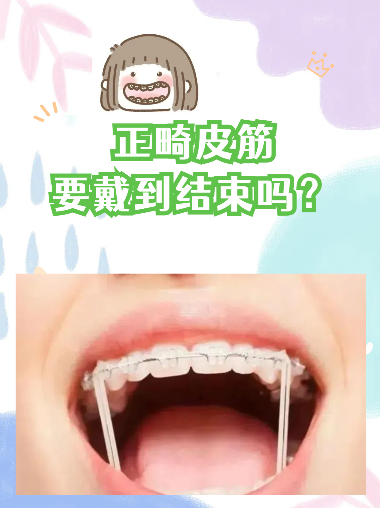 正畸皮筋在牙齿矫正过程中扮演着重要角色,但并不意味着需要一直戴到
