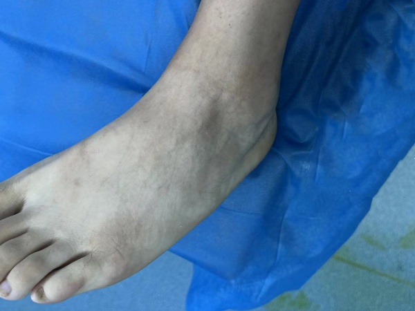 痛风超声出现"双轨征"怎么办?