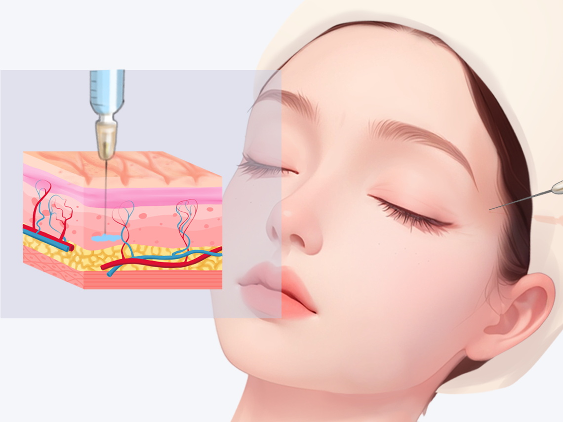 玻尿酸填充凹陷能维持多长时间?解析科学机制与临床实践