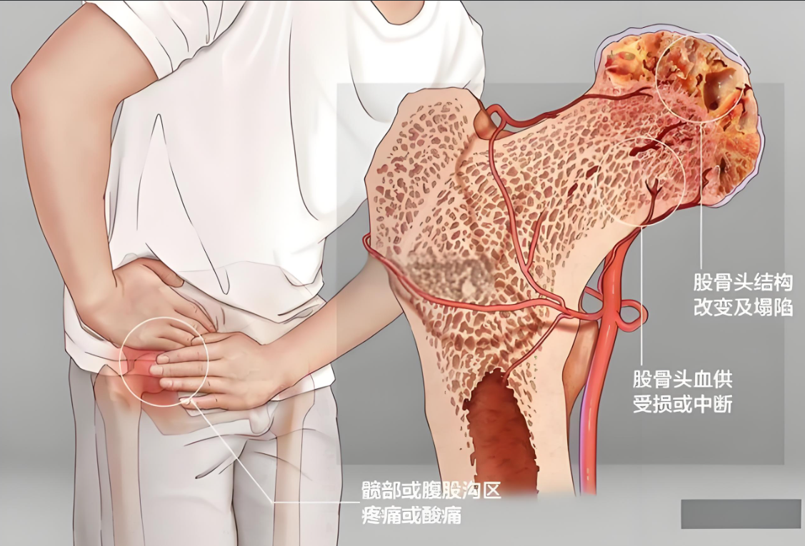 股骨头坏死膝盖疼是不是病情恶化了