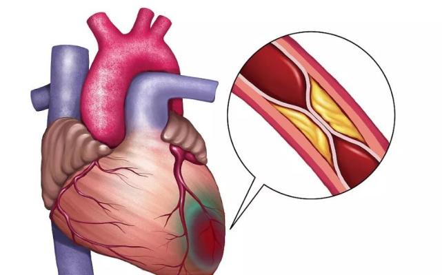 冠心病分类图片图片