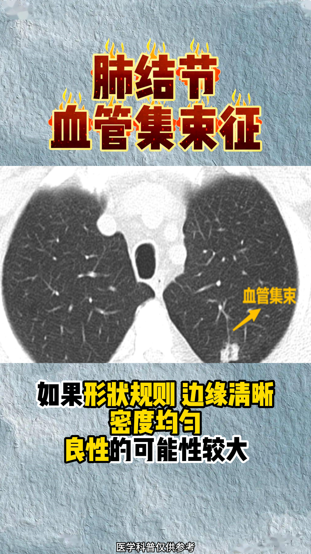 肺结节血管集束征