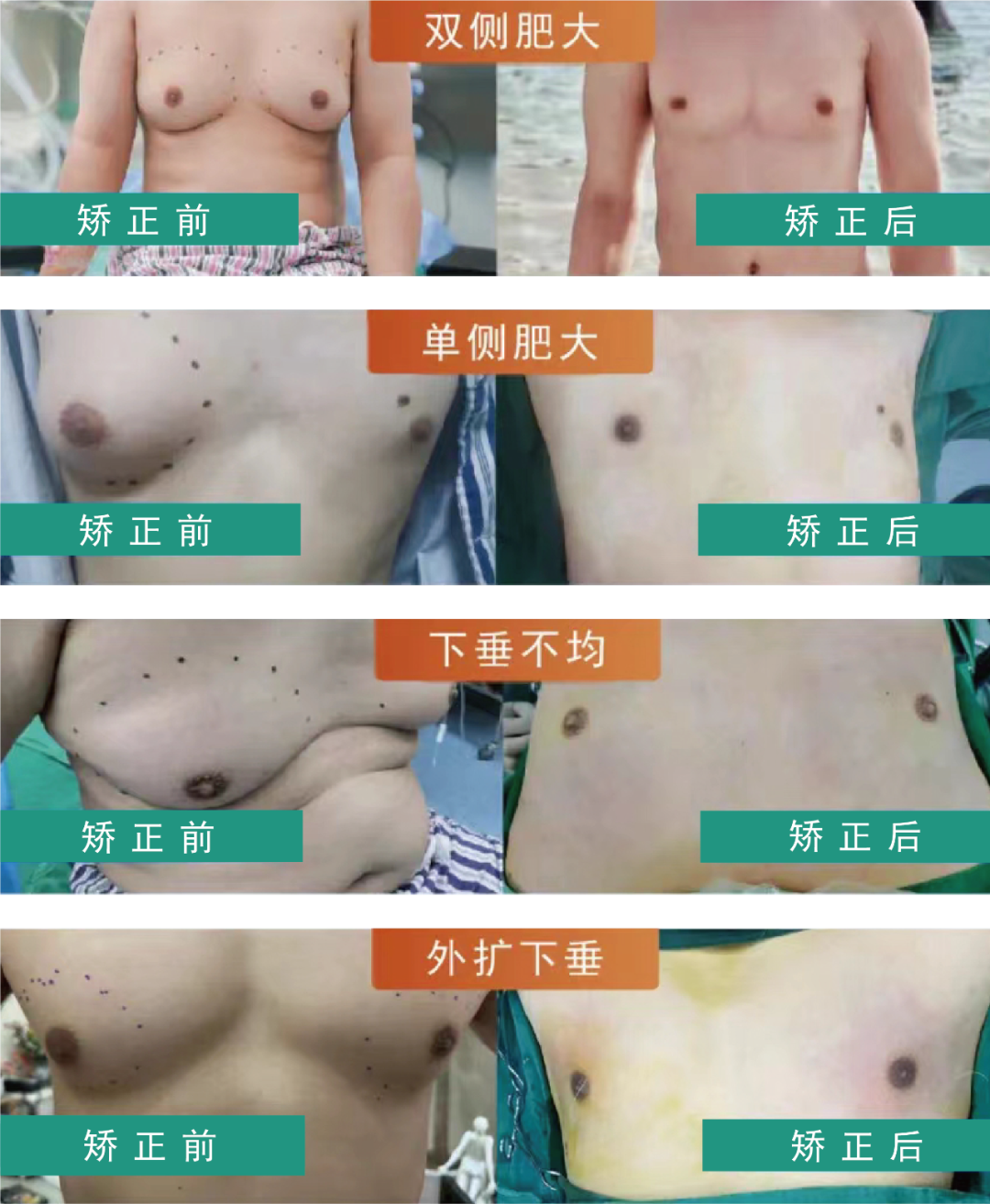 男性乳房肥大症照片图片