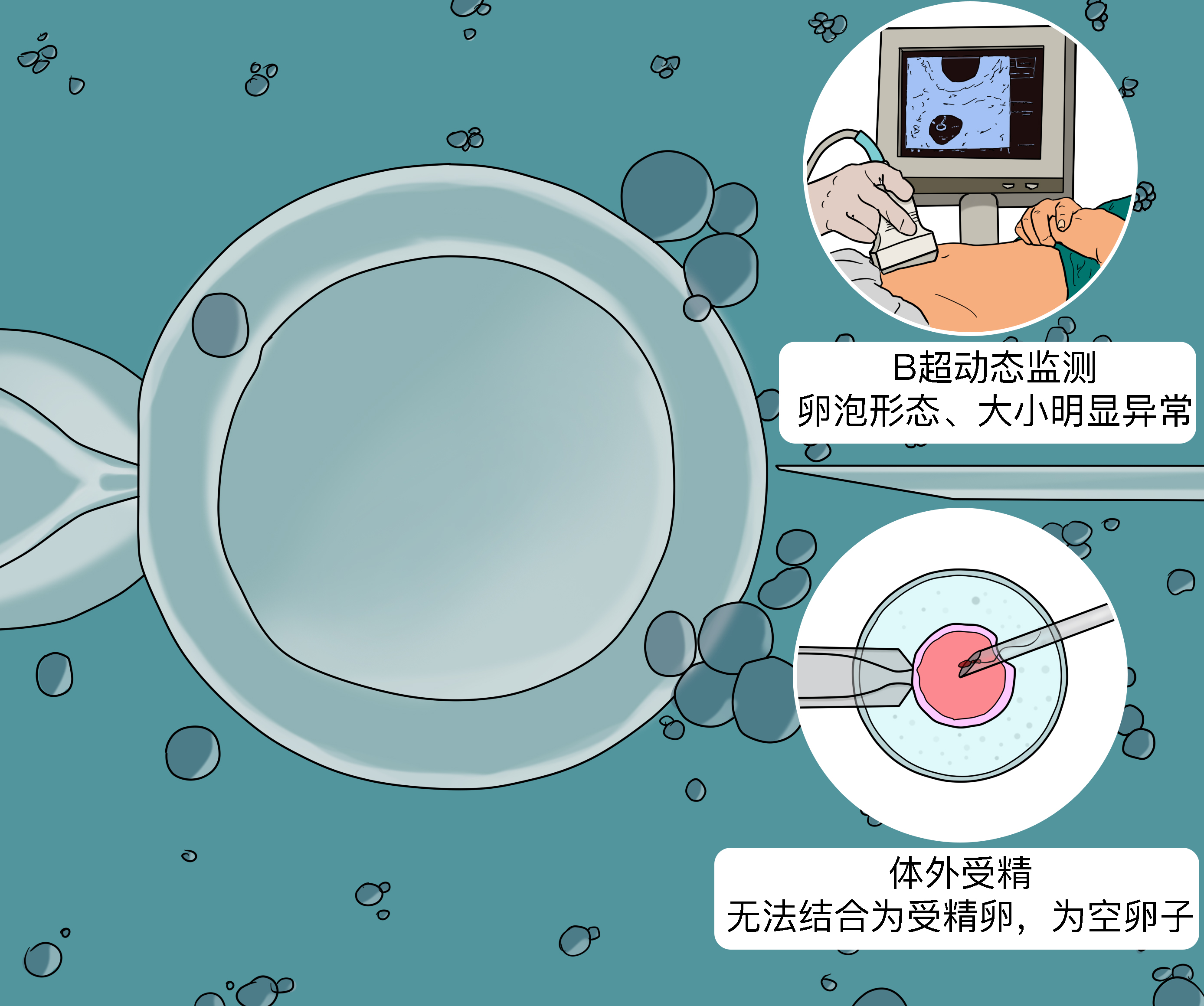 卵泡多个是什么造成的(卵泡多个是什么造成的原因)  第2张