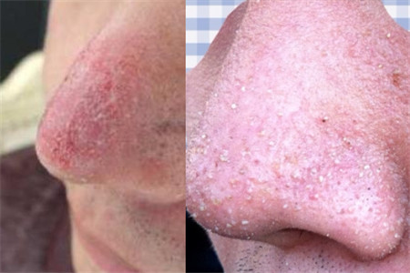 酒糟鼻和草莓鼻一样吗