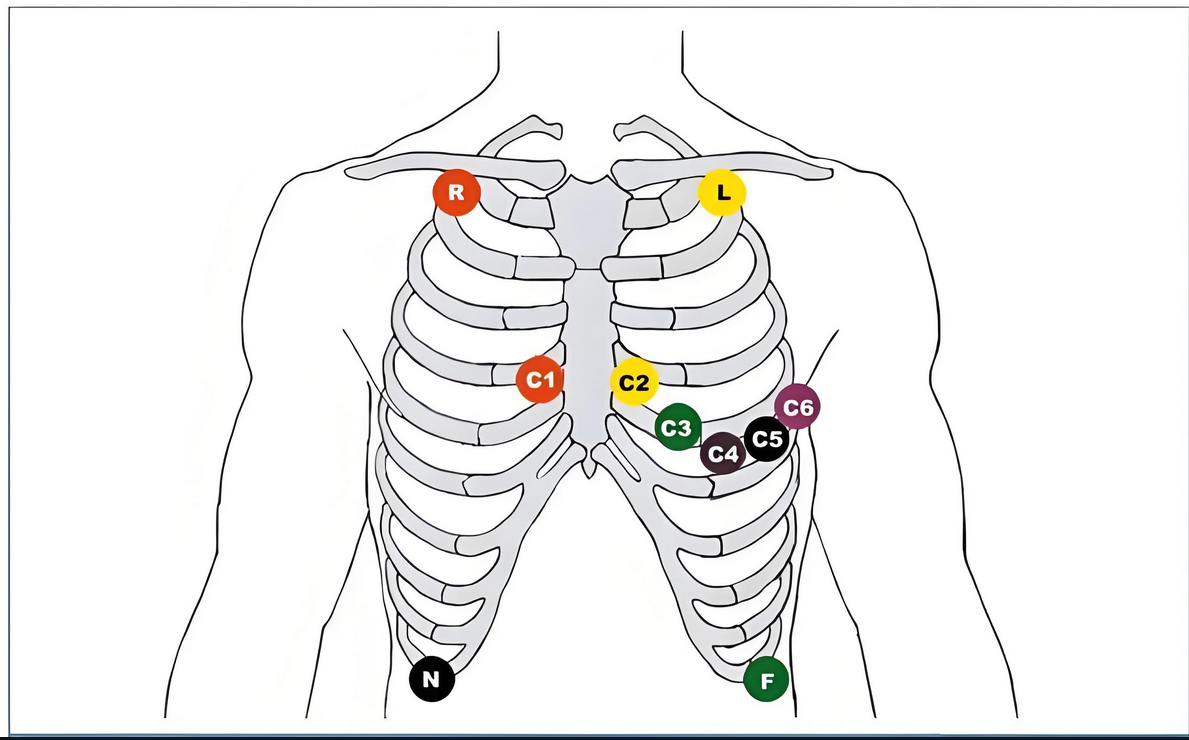 心电图电极位置颜色图片
