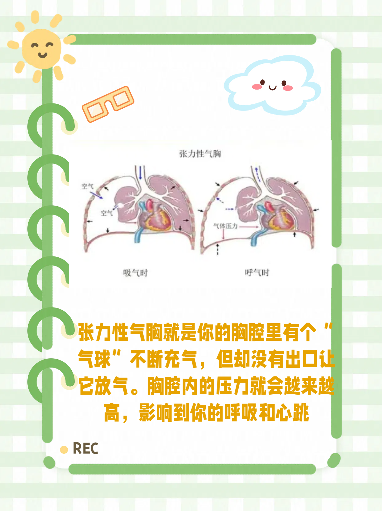 张力性气胸患者图片