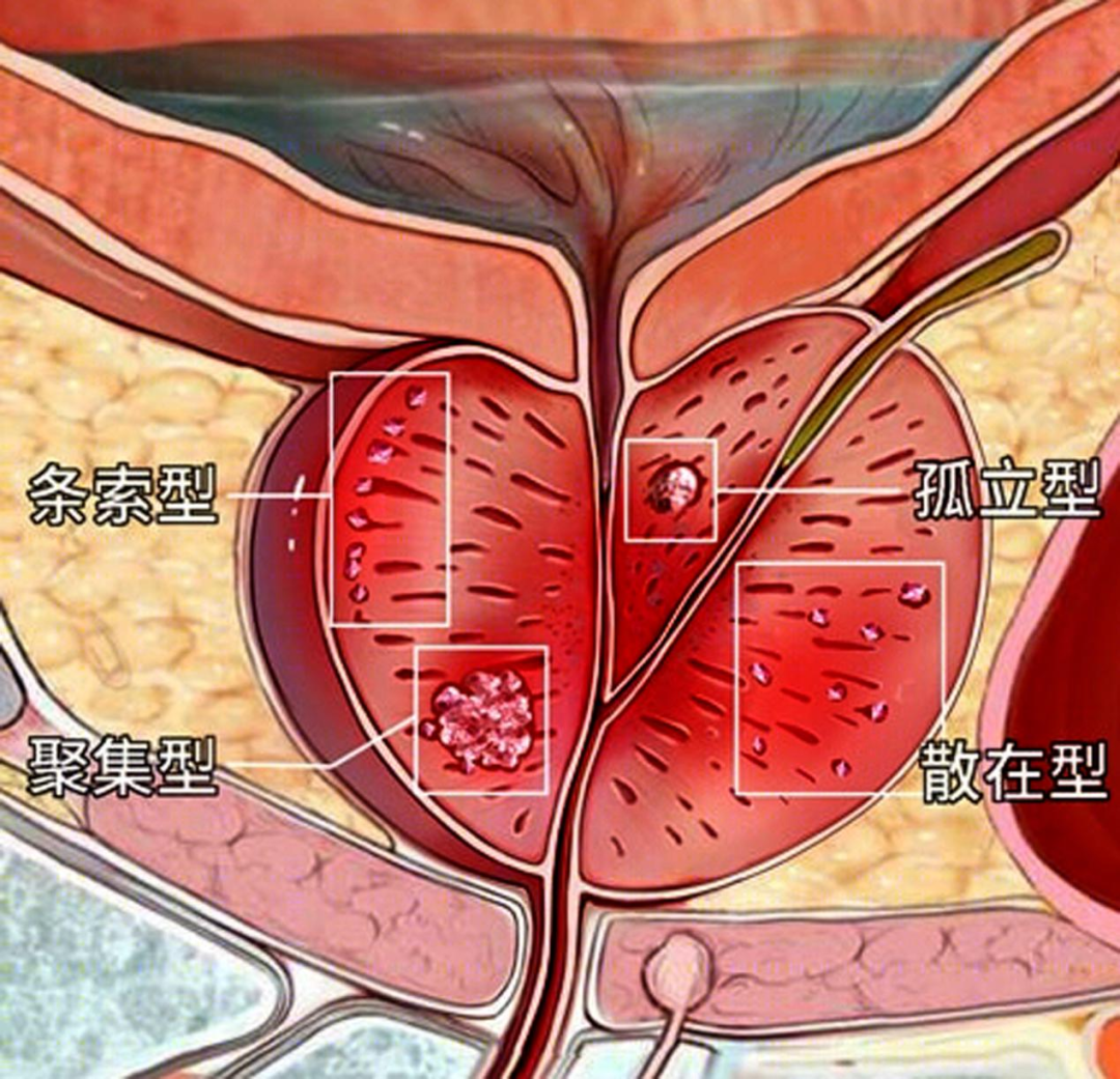 前列腺肥大图片原因图片