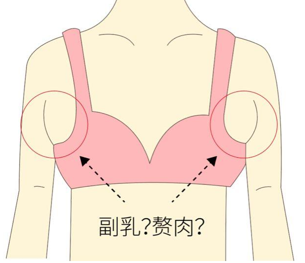 重庆当代整形丨副乳是怎么来的,怎样才可以消除