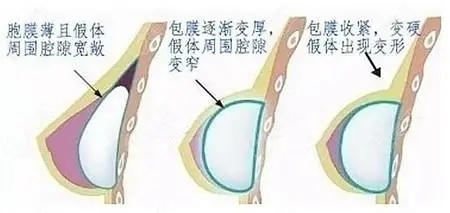 男士假体丰胸效果图图片