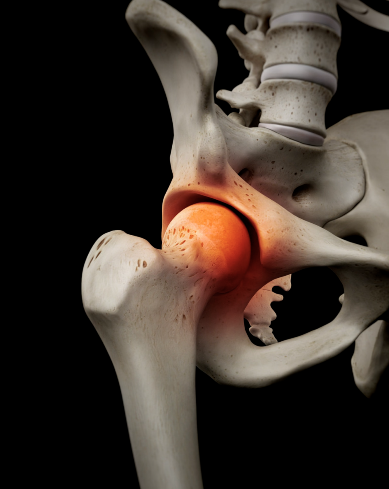 大腿根部隐痛别忽视!股骨头坏死早期信号与防治全攻略