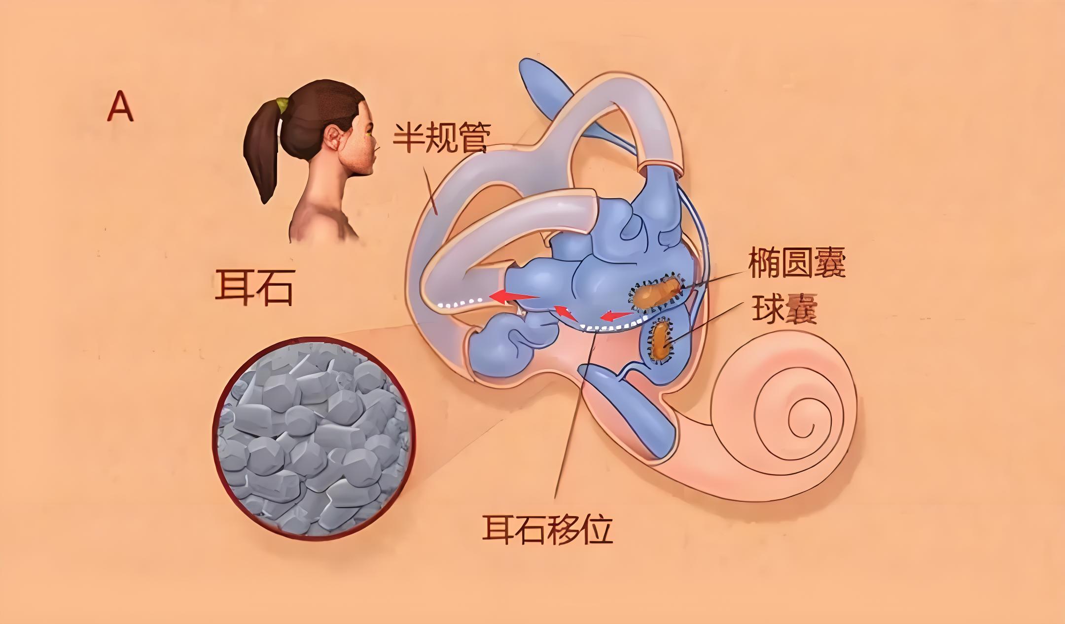 耳朵里的石头会逃跑?一文读懂耳石症发病机制与复位疗法
