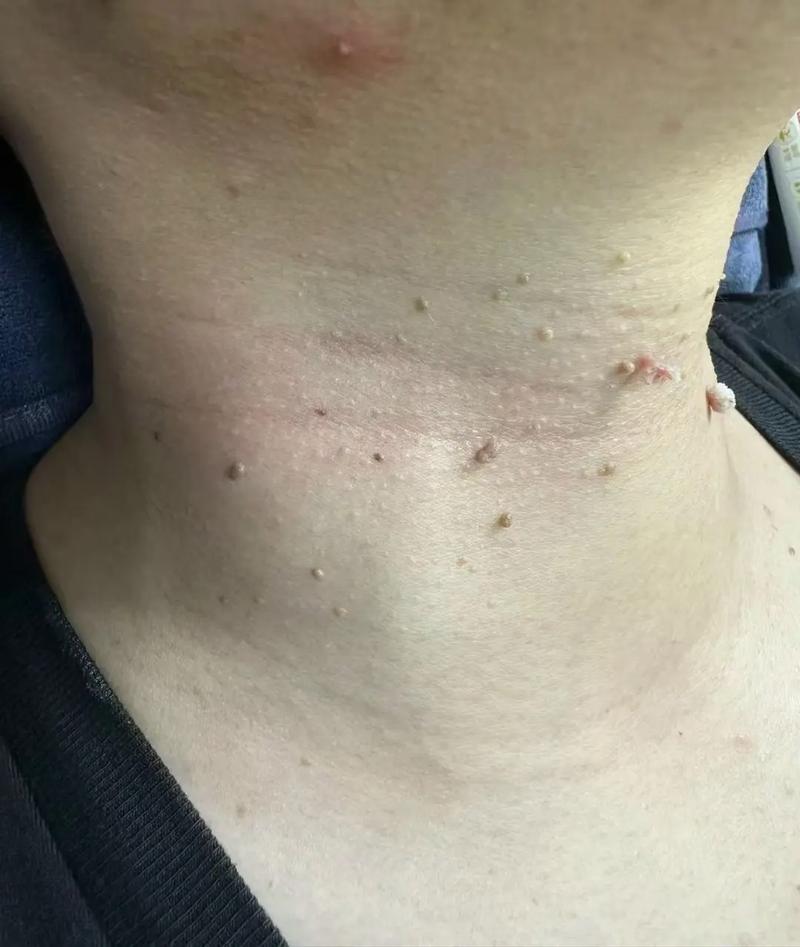 脖子上密密麻麻的小颗粒,其实是丝状疣,会传染!