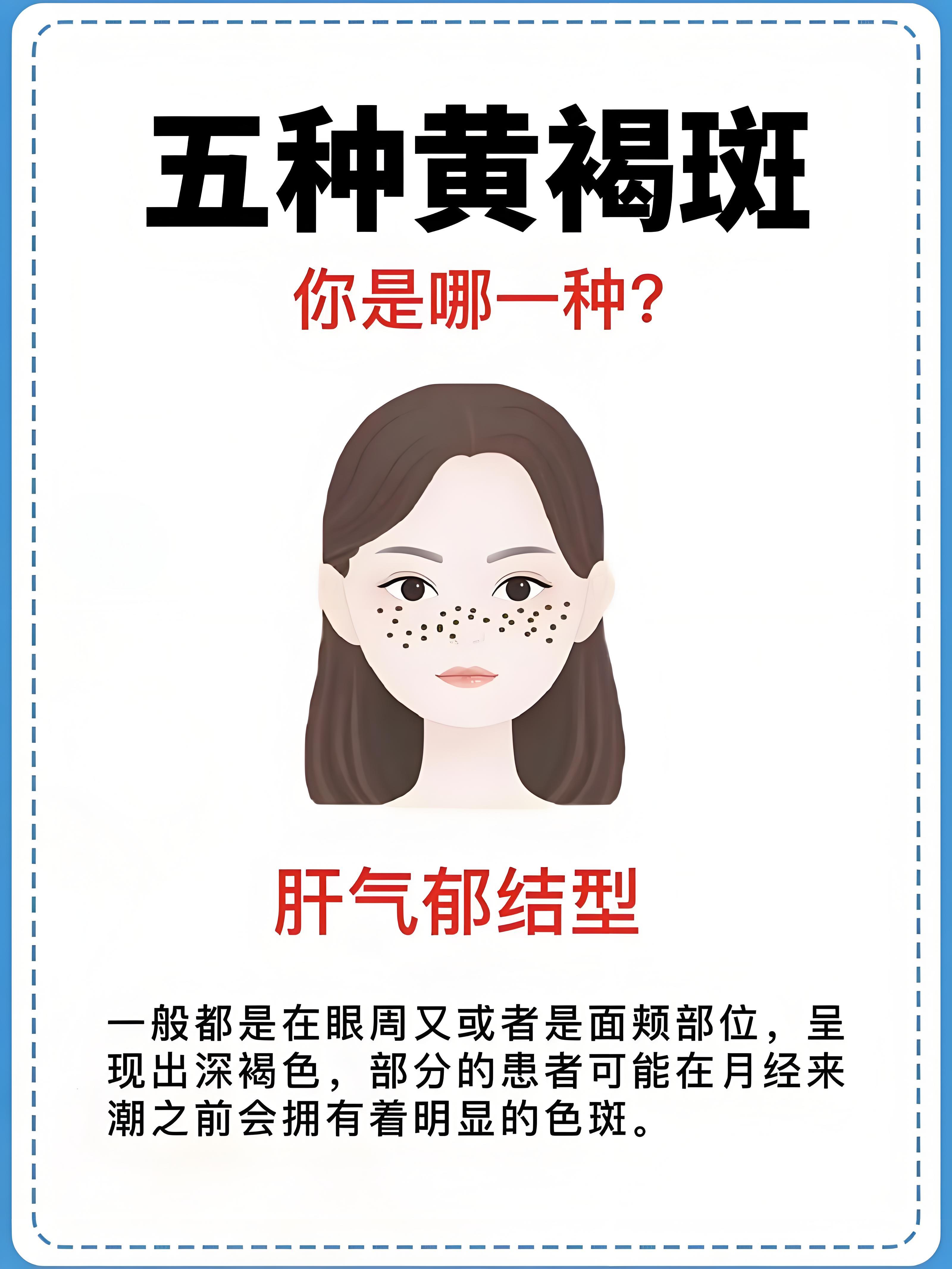 五种黄褐斑 你属于哪一种