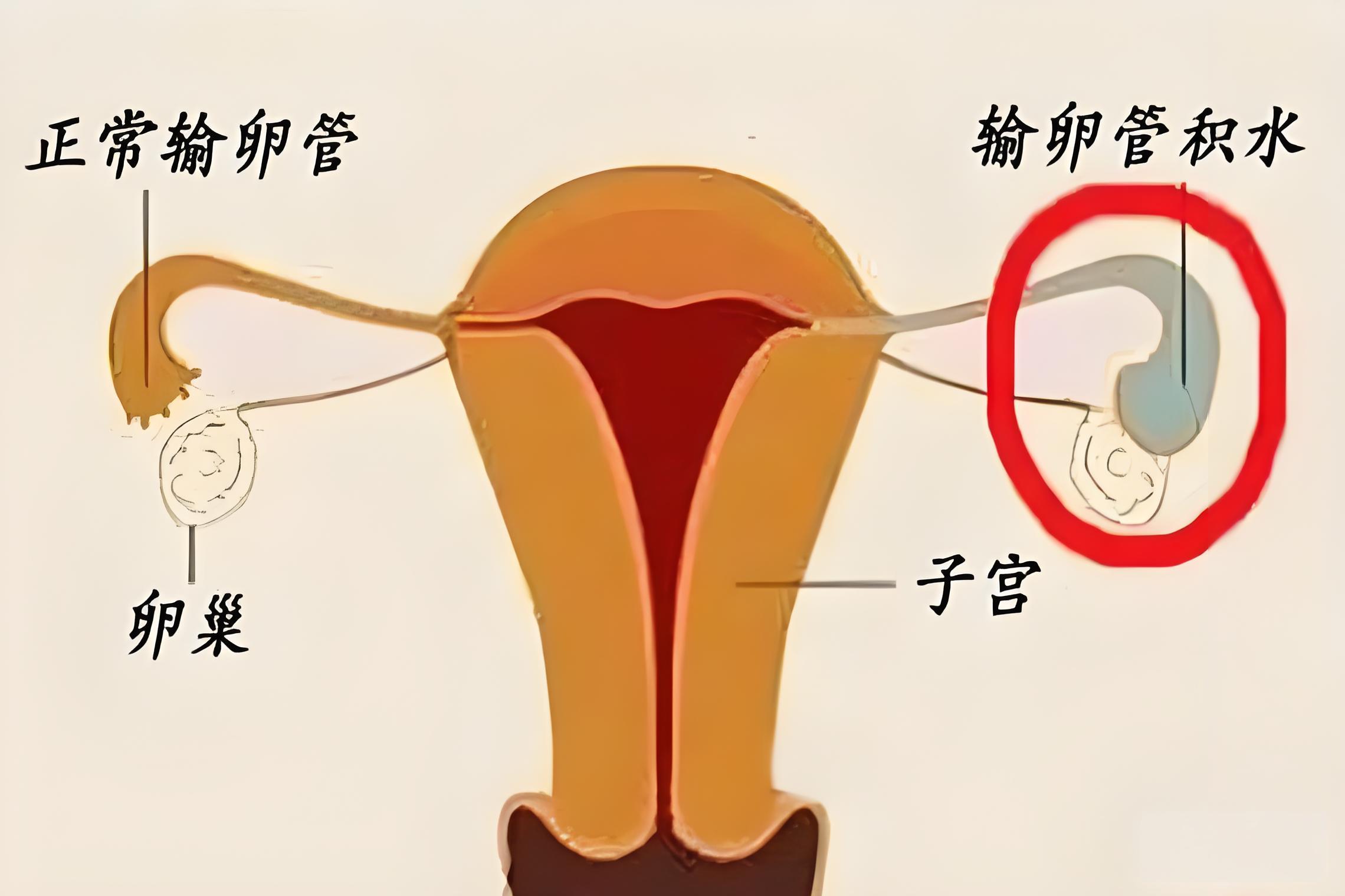 发现输卵管积水,会影响怀孕吗