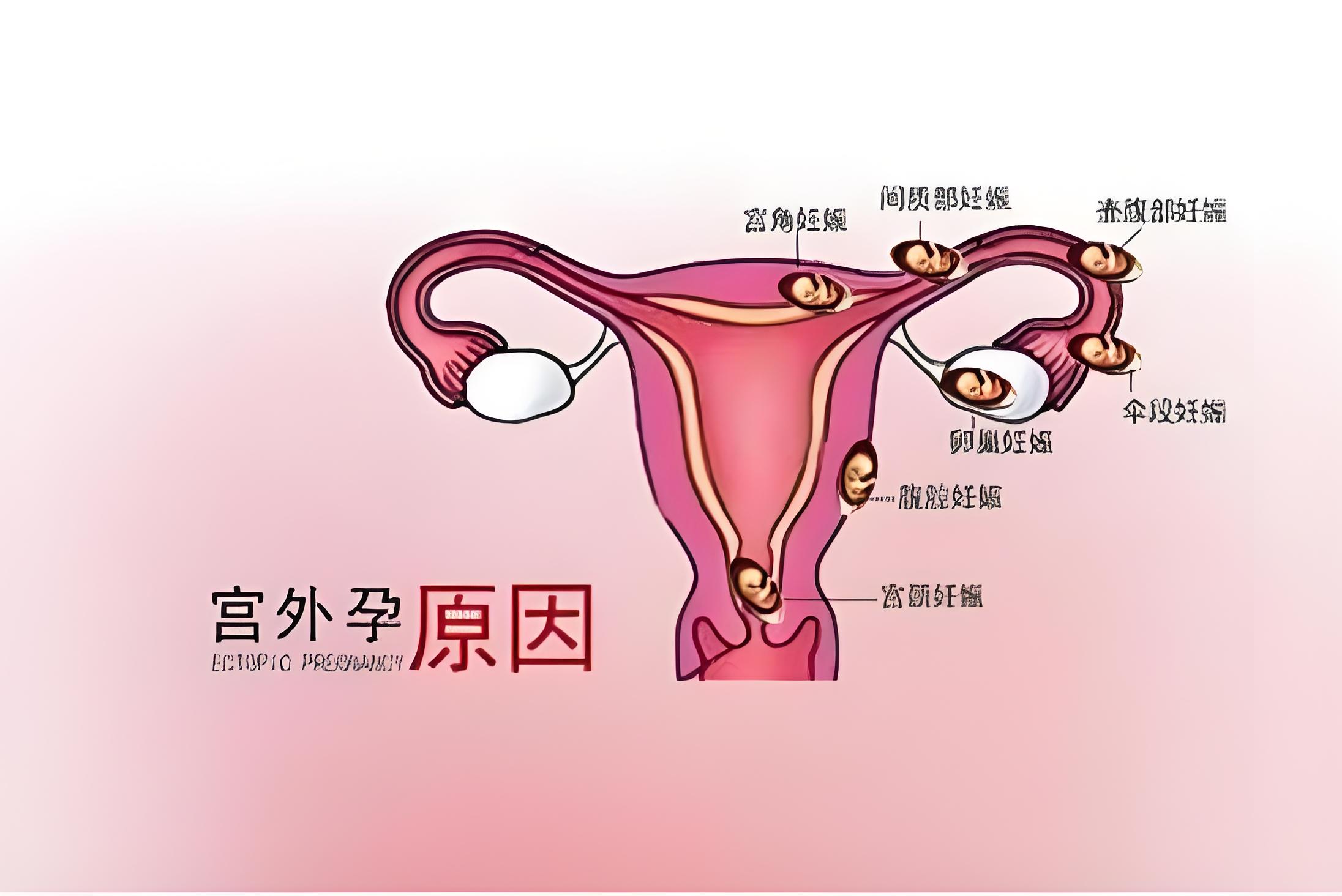 异位妊娠病因图片