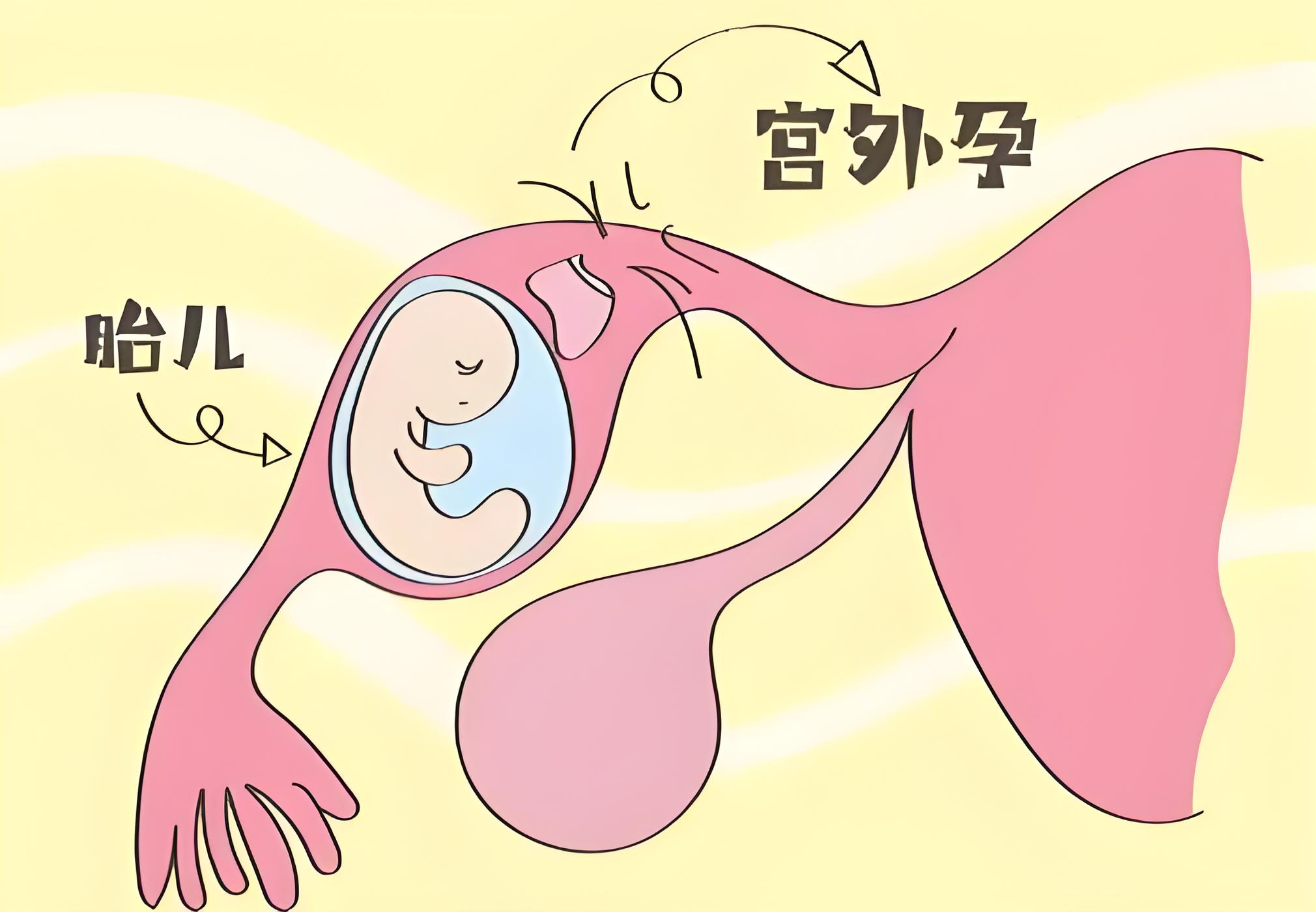 宫外孕,医学上称为异位妊娠,是一种危险的妊娠并发症,指的是受精卵在
