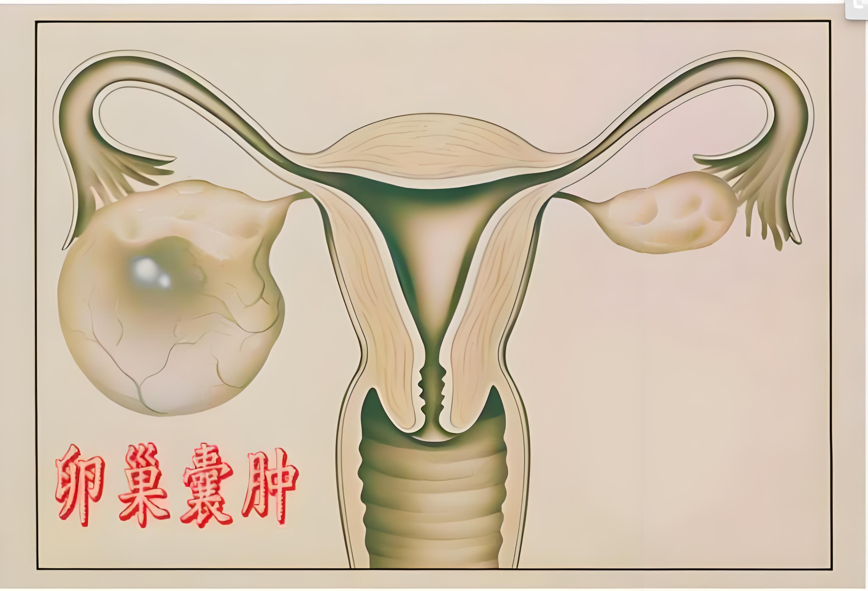 生理性的卵巢囊肿通常是由于排卵周期中的卵泡发育异常或黄体形成引起
