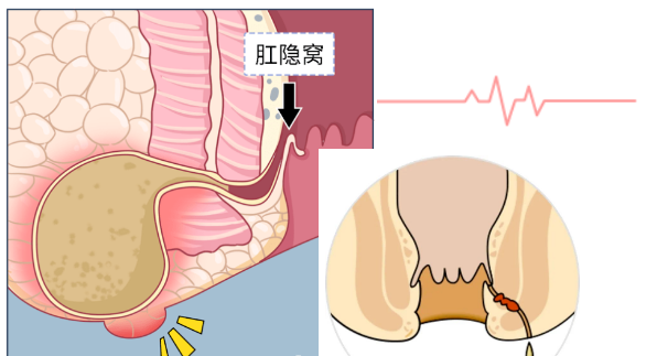 肛周脓肿变肛瘘征兆图片