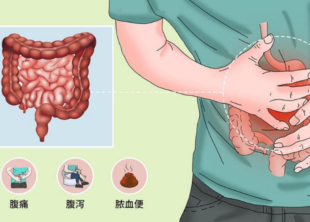 肠息肉会不会再长