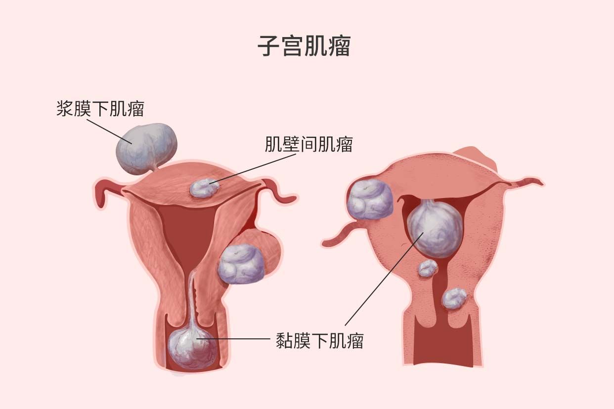 子宫峡部肌瘤图片