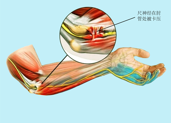 肘管综合征临床表现图片