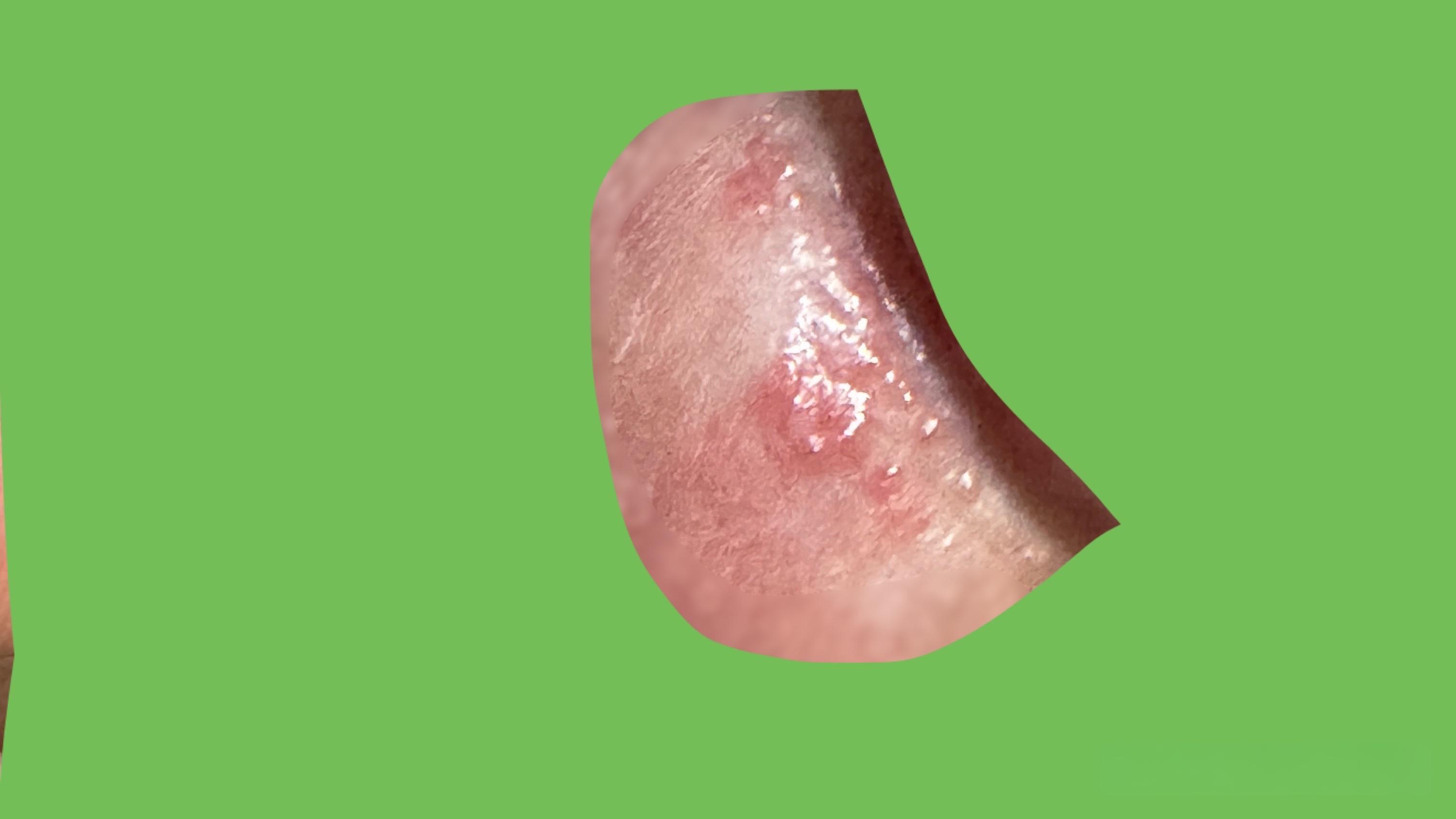 「龟头小肉芽是健康隐患吗?常见原因与科学预防方法解析」