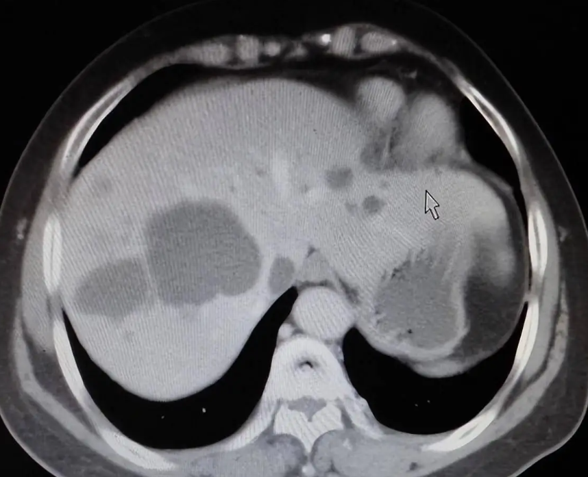 肝囊肿是什么东西?